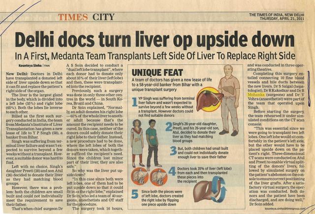Delhi docs turn liver op upside down – dual left-lobe transplant